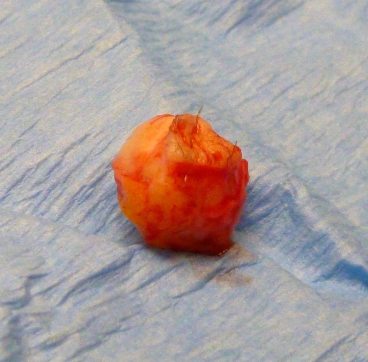 This cyst is just a bit bigger than a large pea.