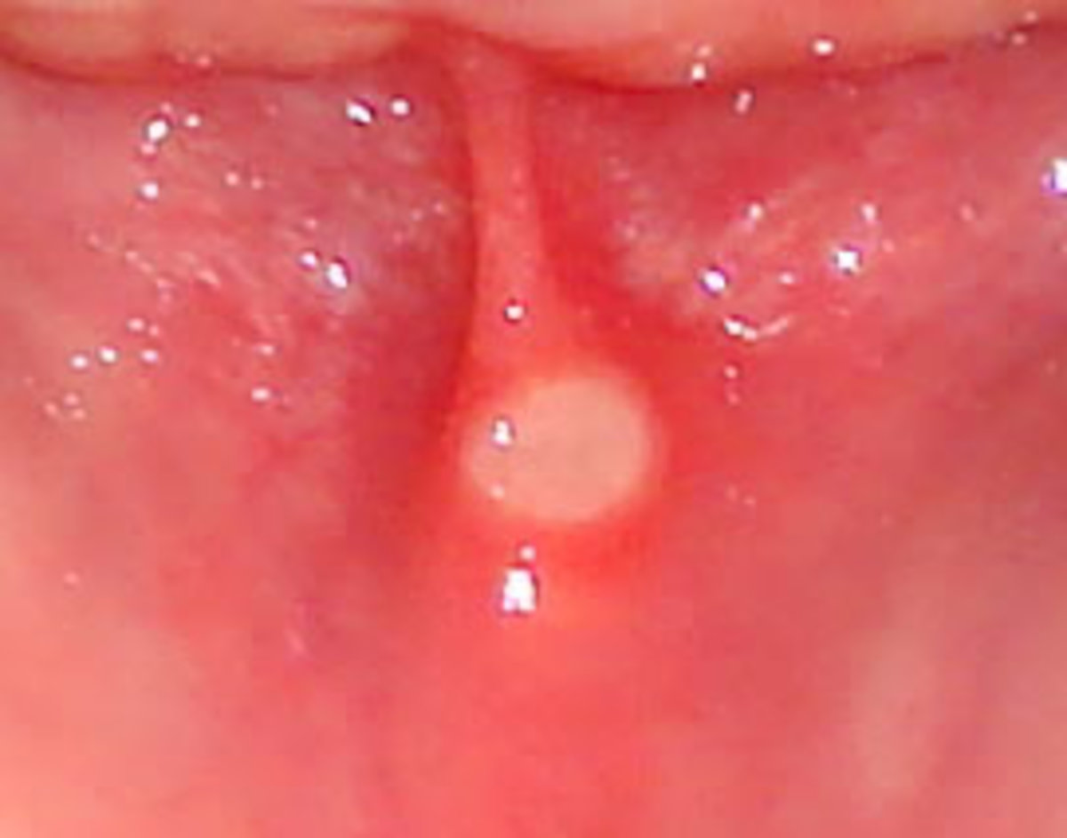 Canker sores are definitely small but terrible!
