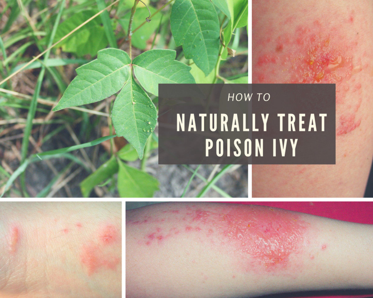 A Natural and Fast Poison Ivy Cure