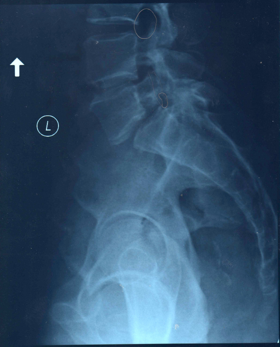 Compression of the sciatic nerve, by lumbar spondylosis shown on an xray.