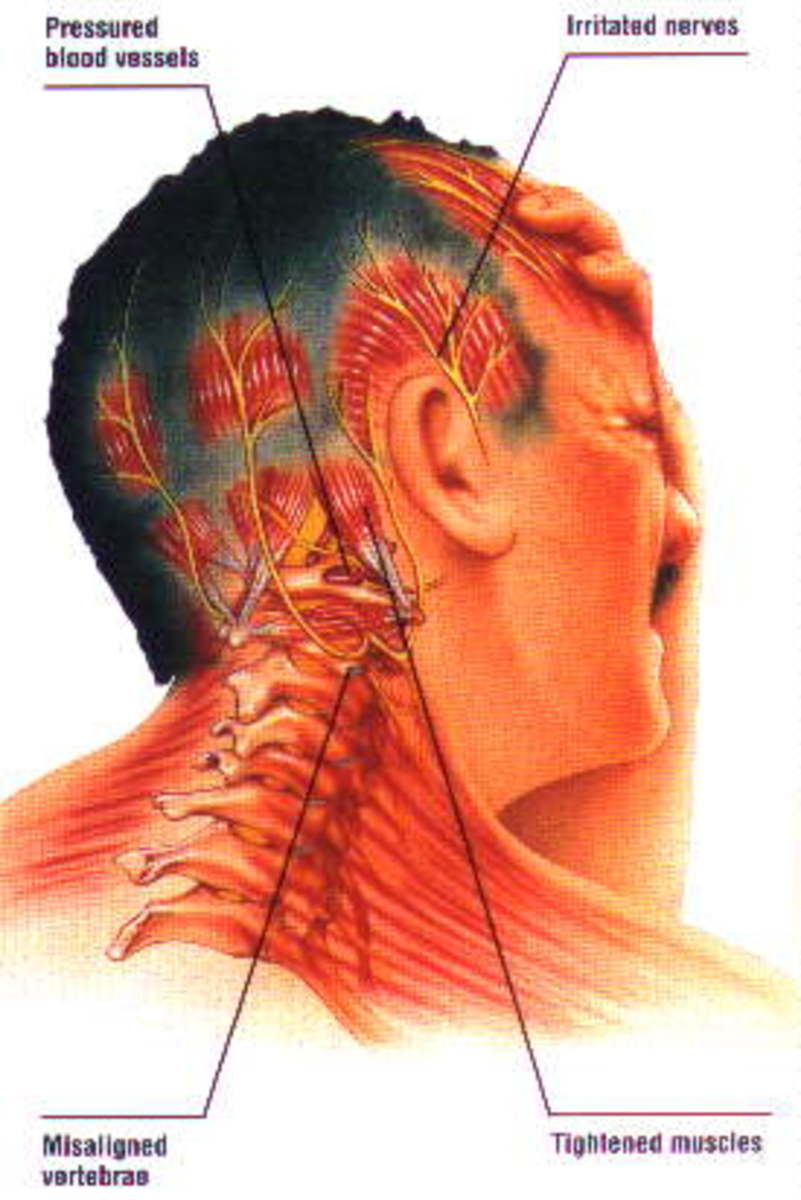 Can Neck And Spine Misalignment Cause Migraines HubPages