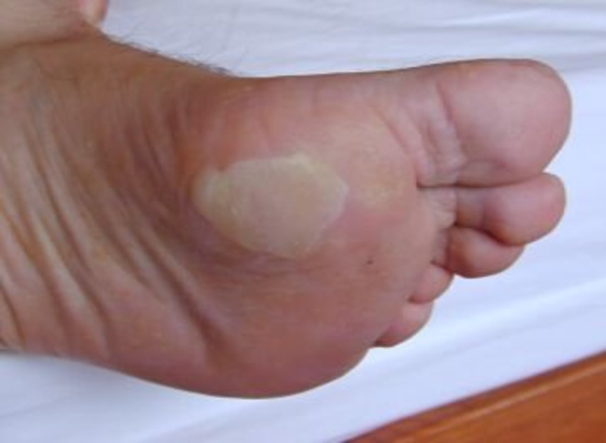 Foot blister
