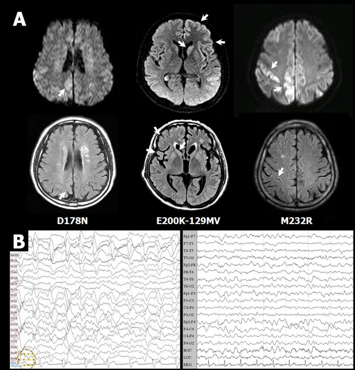 Imaging studies and EEGs are used to define and diagnose post-op siezures.