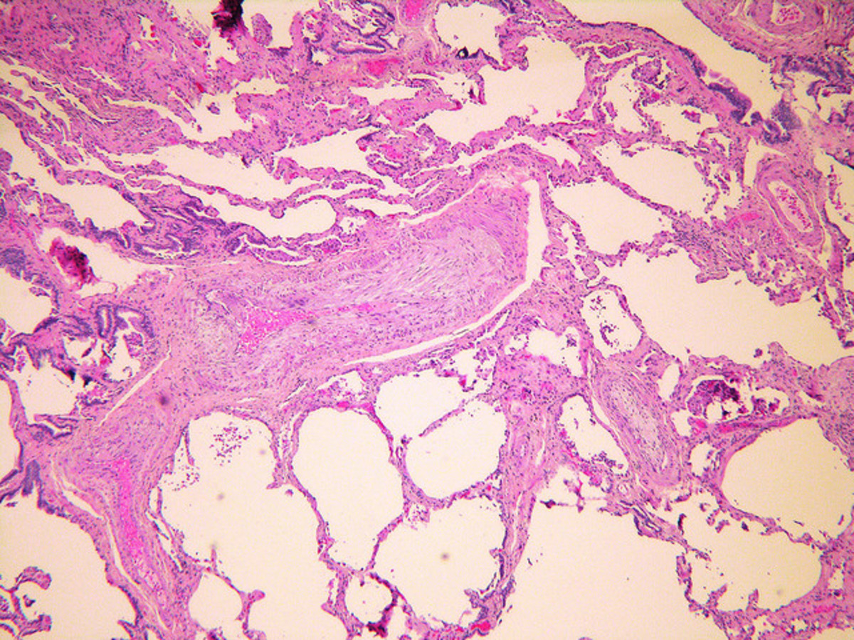 A histological image of the lung. Notice the clots (magenta dots) blocking the pulmonary arteries (central and bottom-left structures).