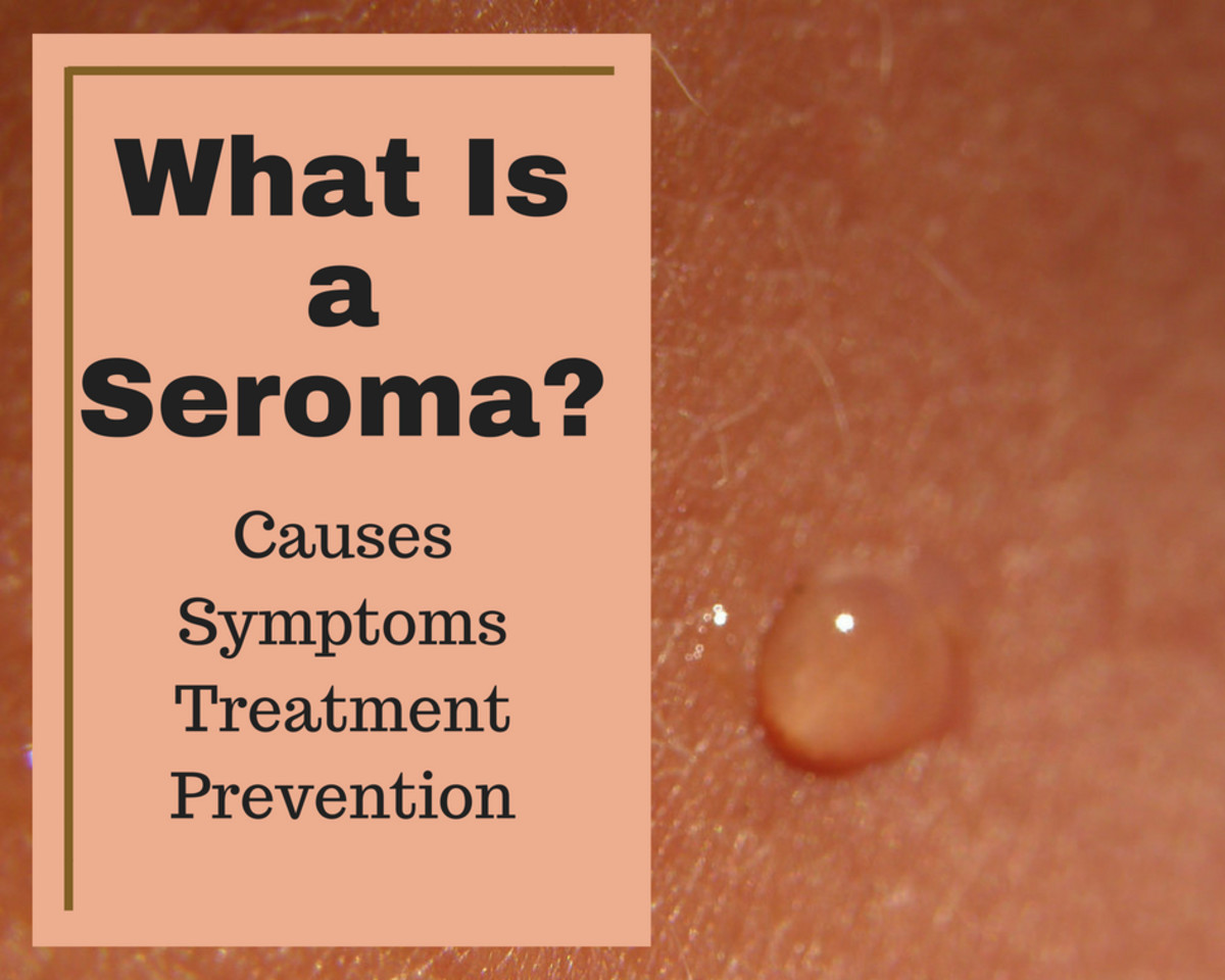 What is a seroma?