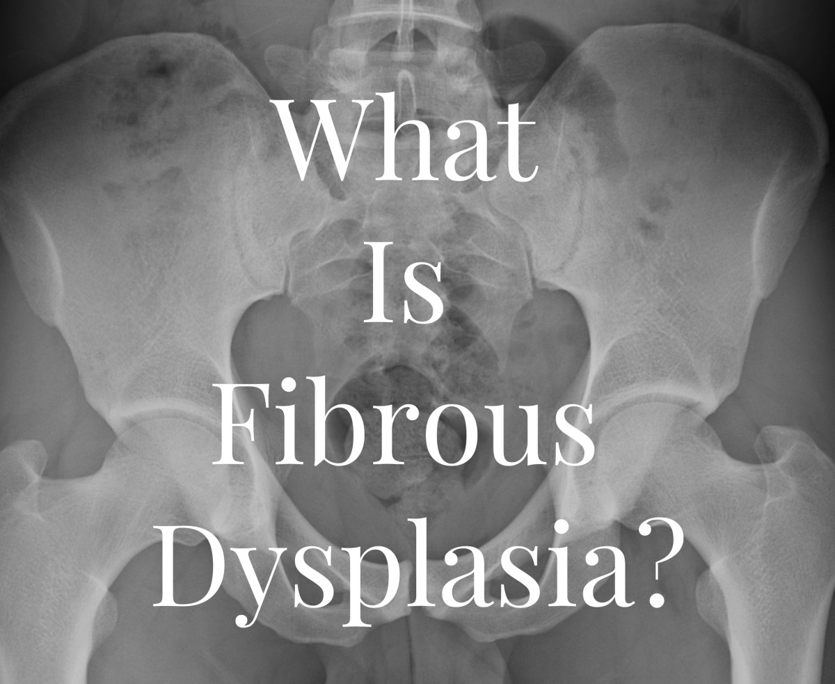 My Diagnosis: Fibrous Dysplasia