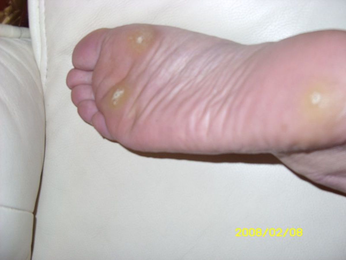Three plantar warts appear as off-white spots on the bottom of the patient's foot.