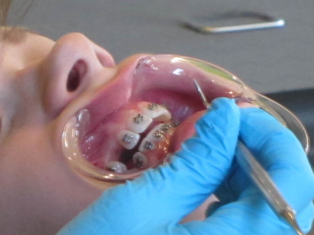 Here's how you will look after all the brackets have been put on your teeth.