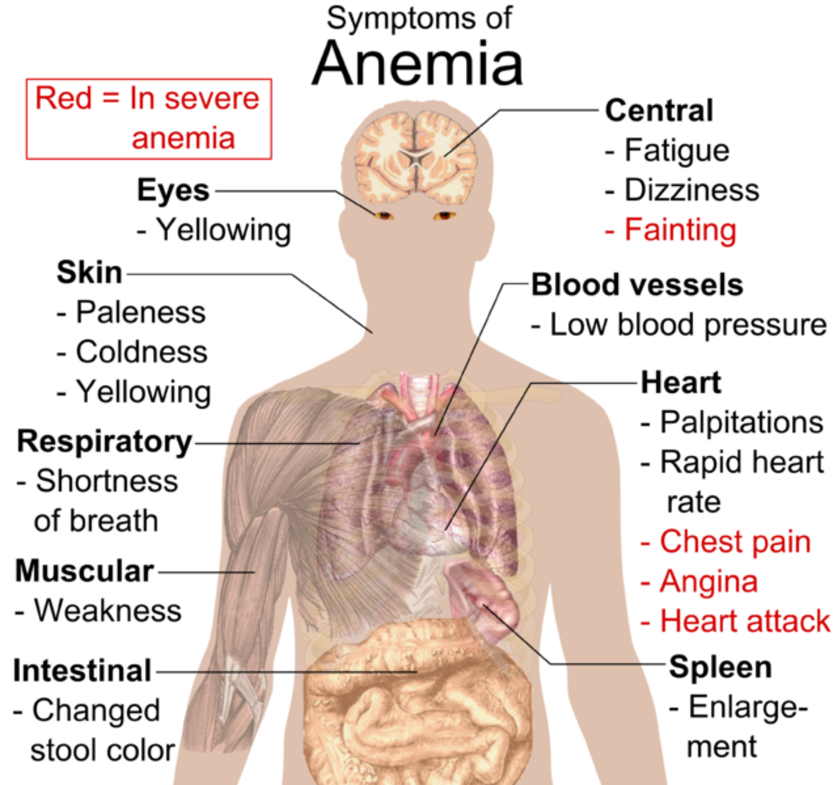 Diagram summarizing anemia symptoms