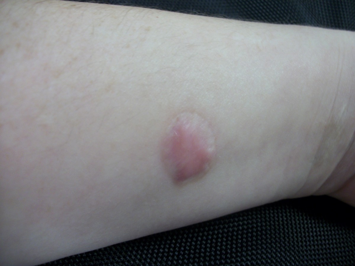 Nine months after my burn, I still have an unsightly scar.