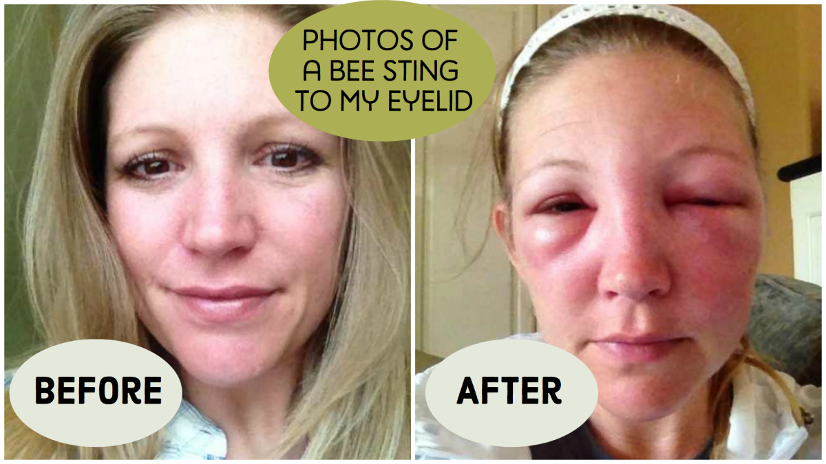 My Experience Of A Bee Sting Near My Eye With Photo Progression 