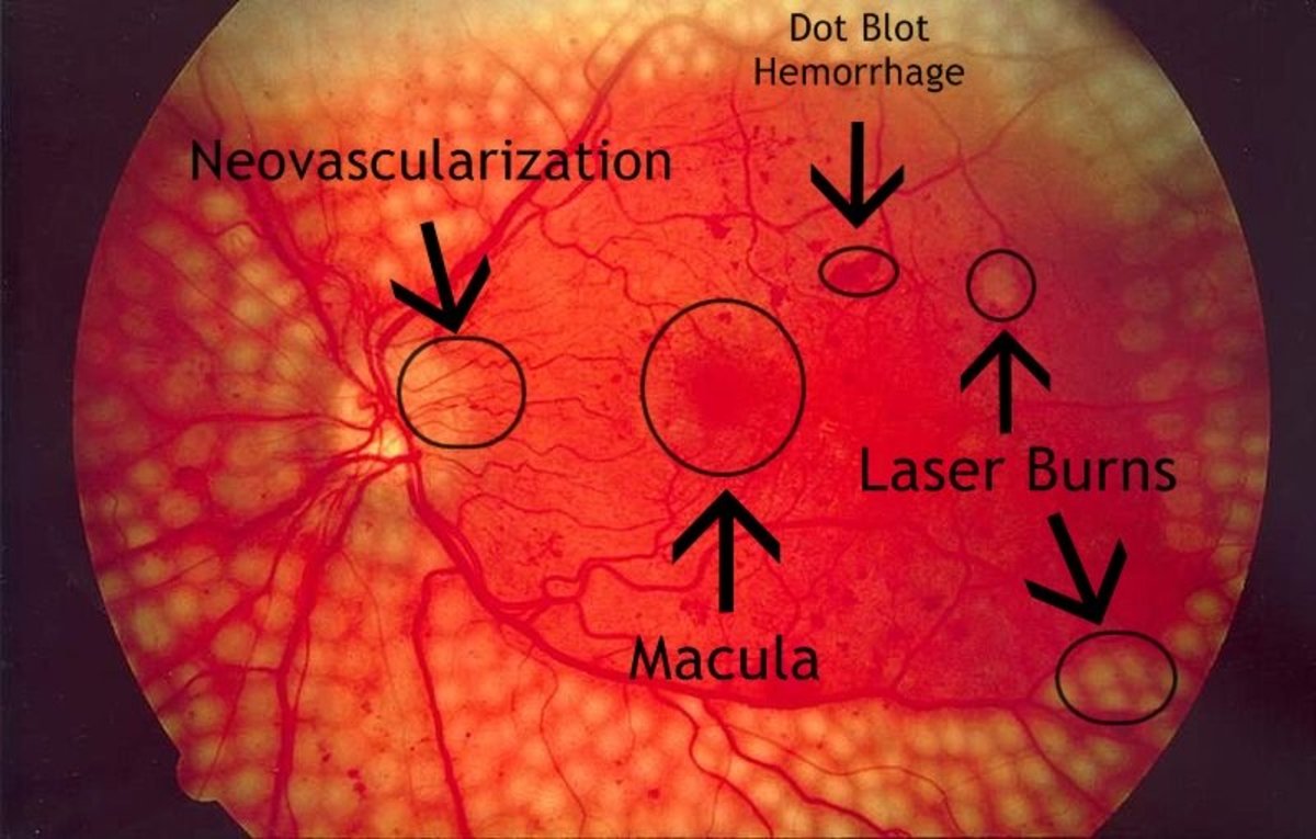 A fundus image of diabetic retinopathy