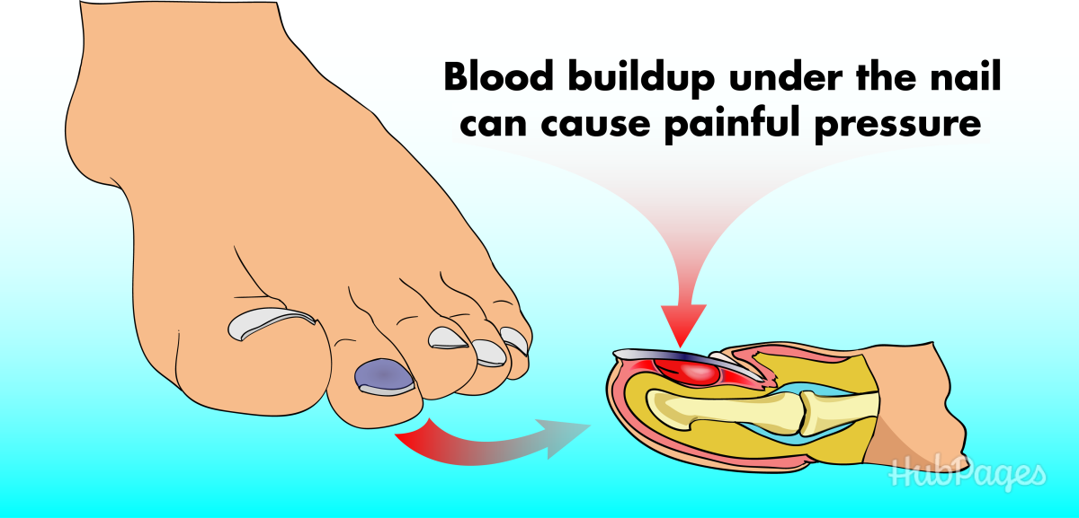 A blood blister, or sublingual hematoma, is caused by blood buildup under the nail, which can create painful pressure.