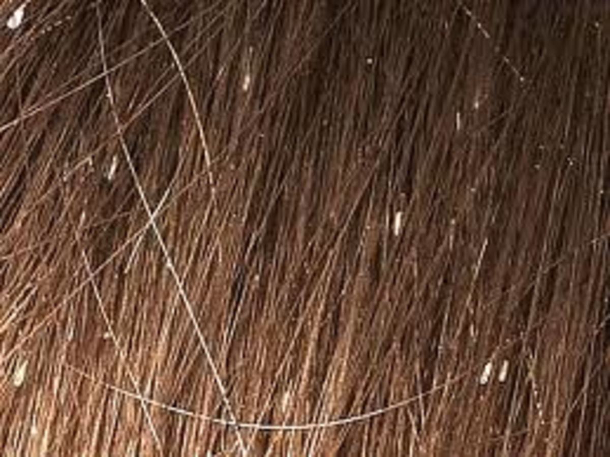 What You Need to Do to Get Rid of Lice and Nits - WeHaveKids