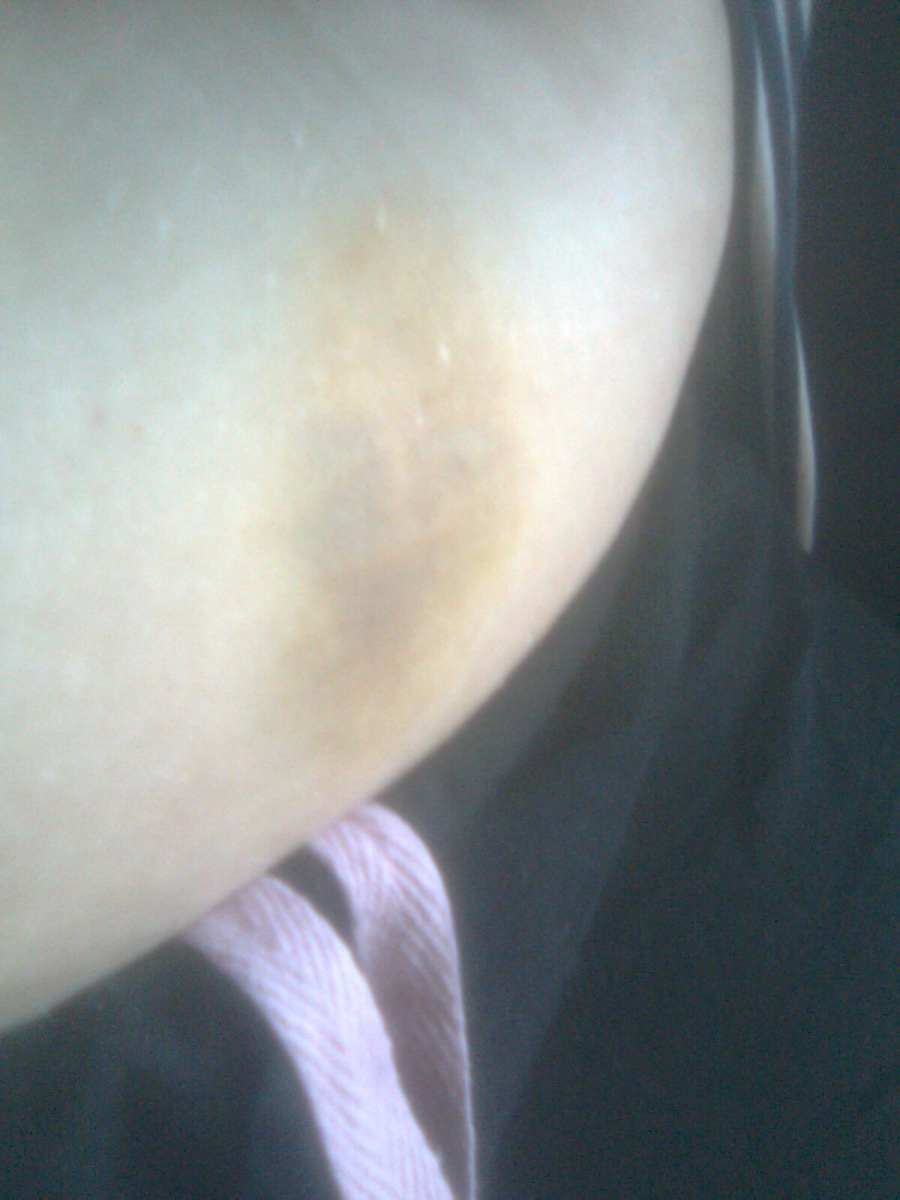 This is what a hematoma can look like on the outside when healing.