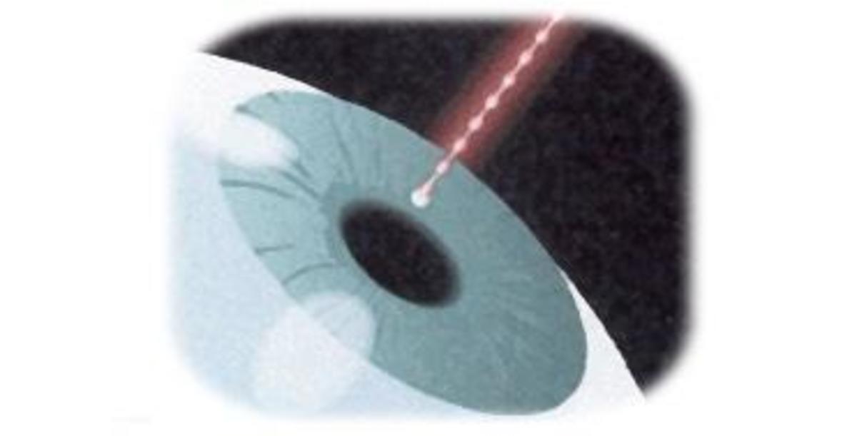 Laser Iridotomy treats glaucoma by making a small pinhole in the iris of the eye.