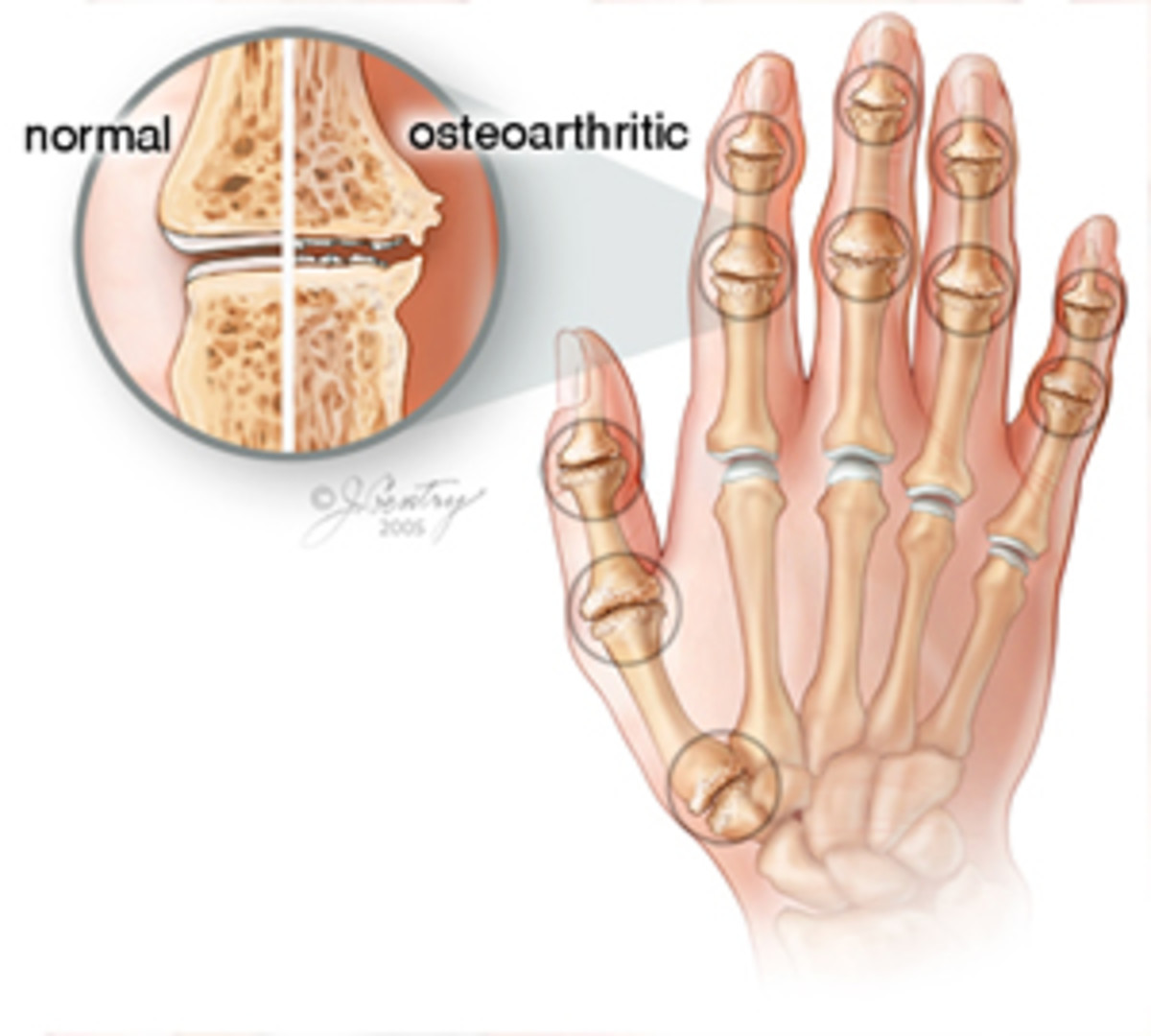 massage-therapy-for-osteoarthritis-pain-remedygrove