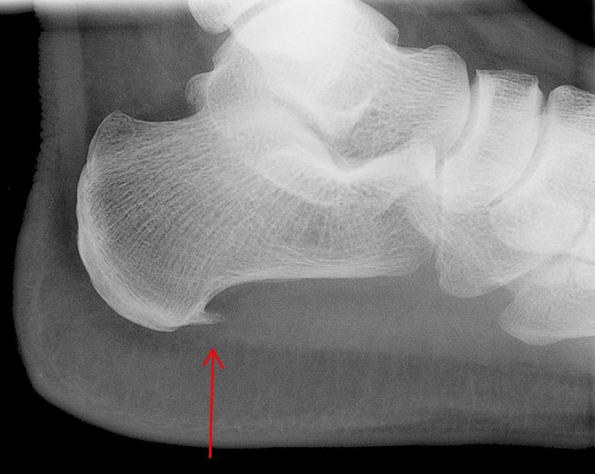 A bone spur on the heel of a person suffering from plantar fasciitis