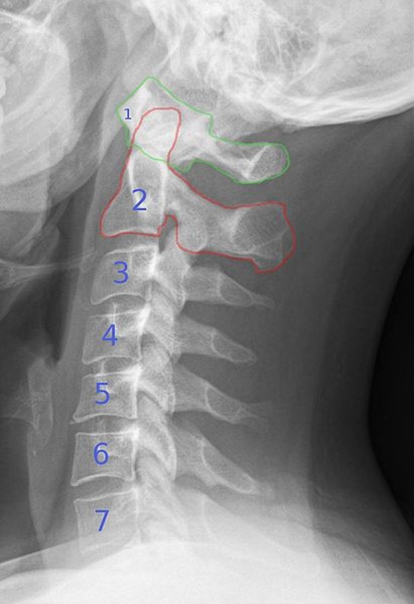 An X-Ray of the Cervical Vertebrae