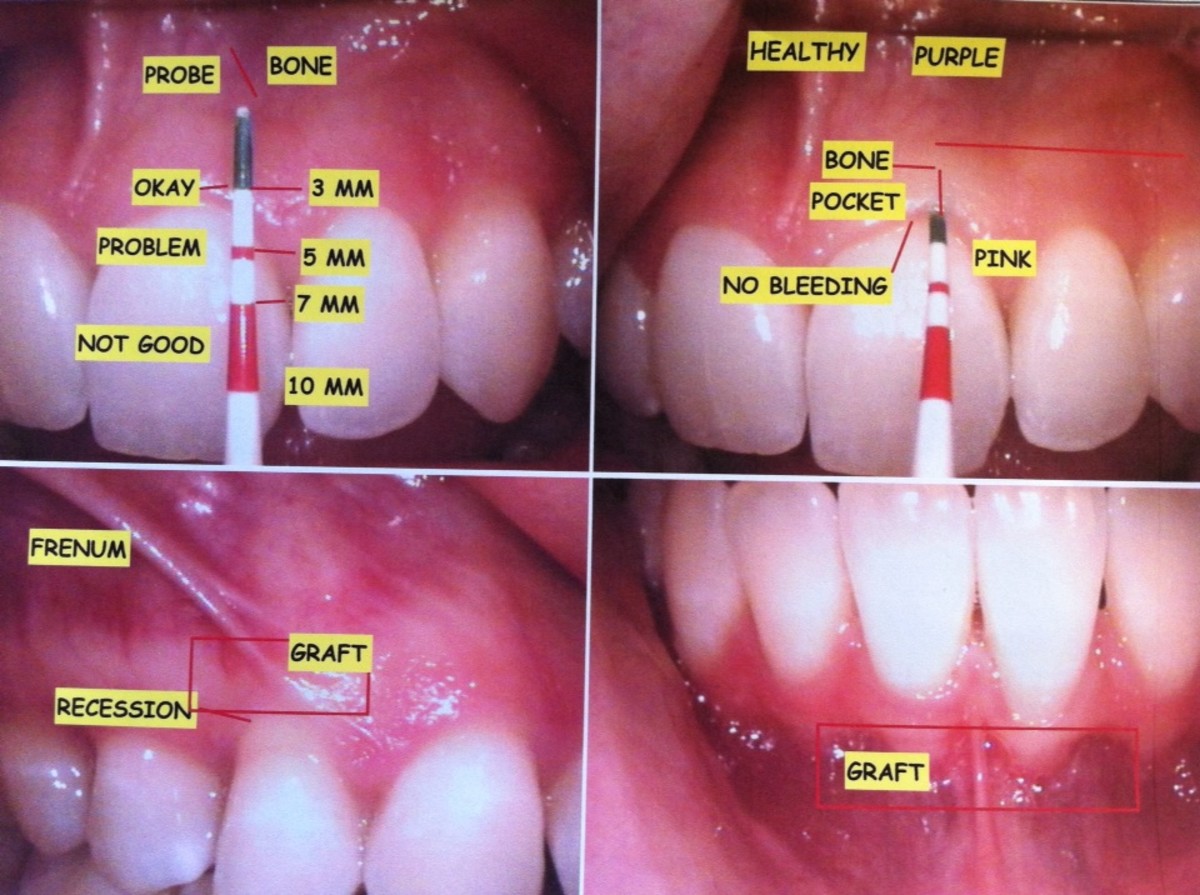 Check out my super gross teeth! As you can see, the teeth in the two bottom panels need grafting. The instrument in the images at the top is used to check for inflammation and other gum disease issues.