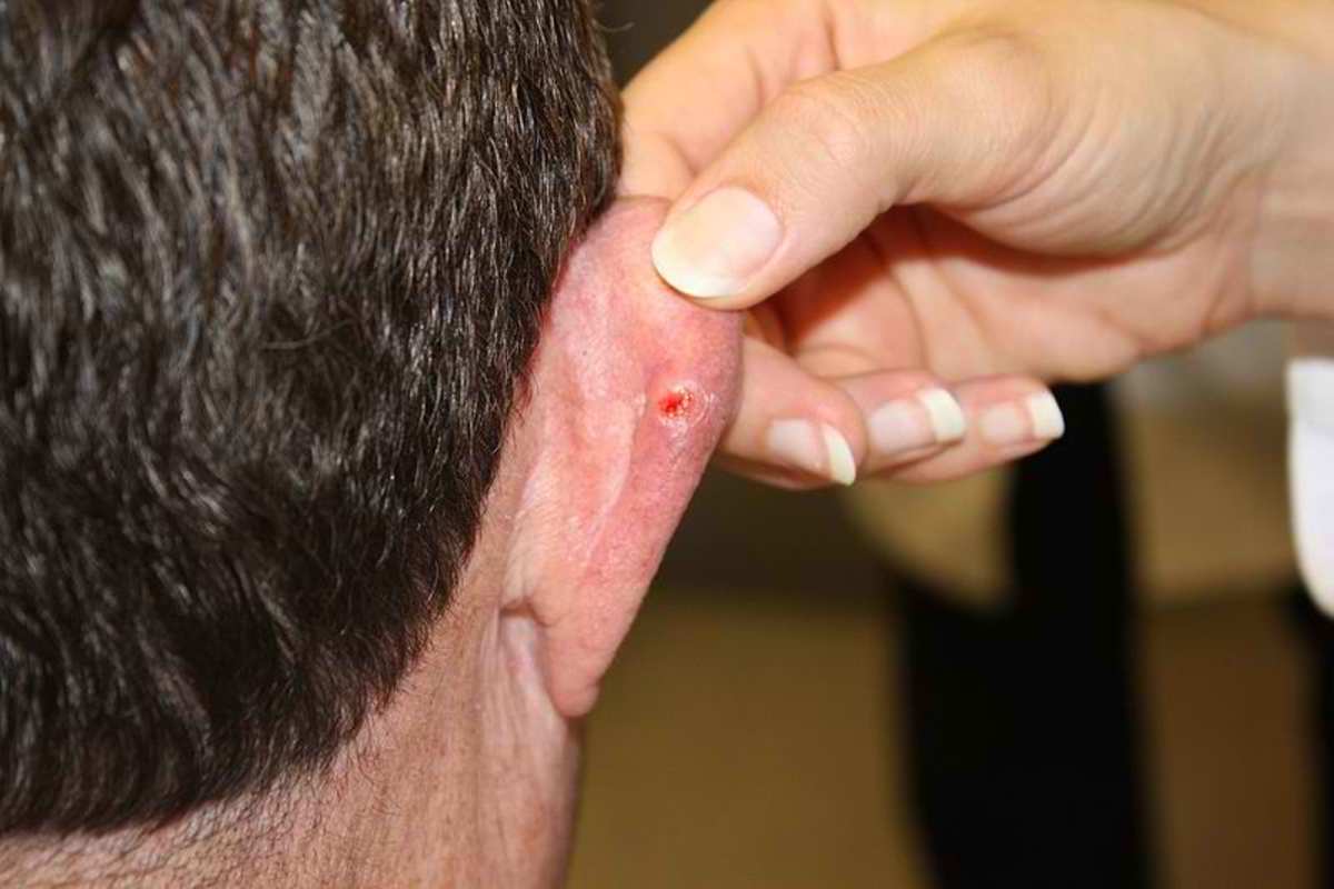 A red, ulcerated lesion surrounded by a white border on the skin of the right ear. Ulcerated basal cell carcinoma with characteristic pearly rim.