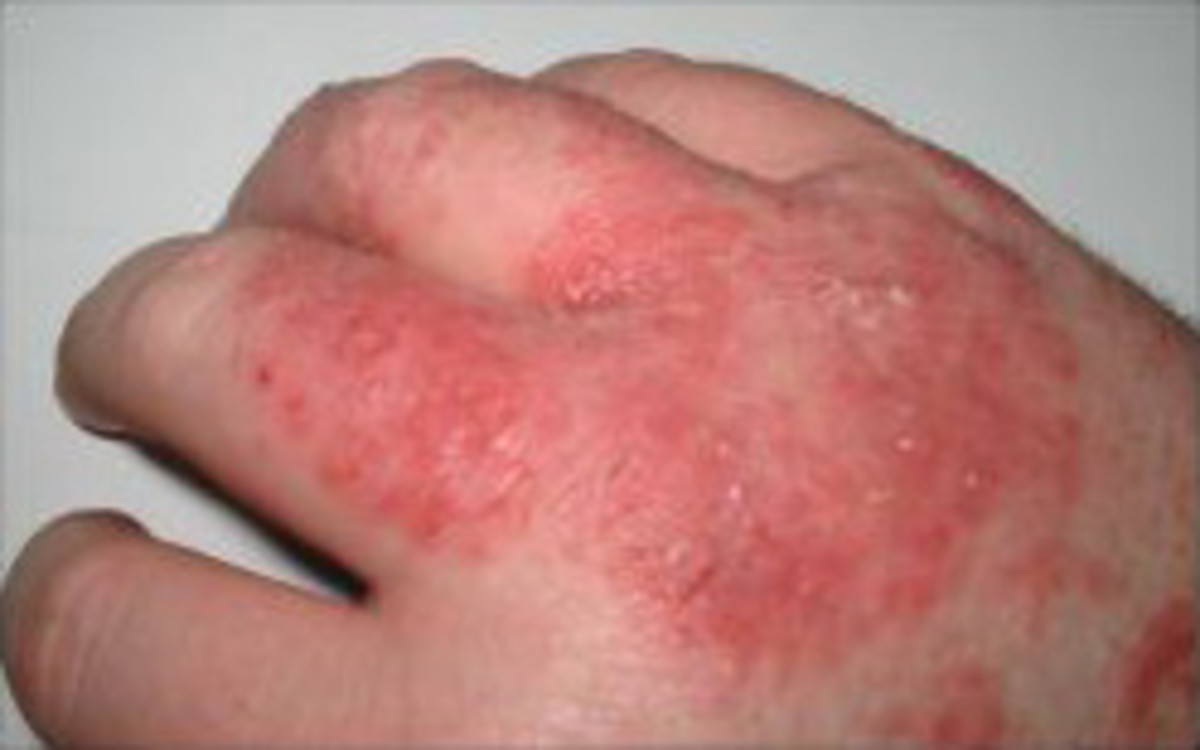 Eczema typically manifests as a rash, often accompanied by tiny blisters.