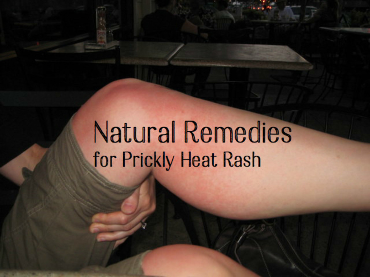 10 Ways to Cure Prickly Heat Rash With Natural Home Remedies