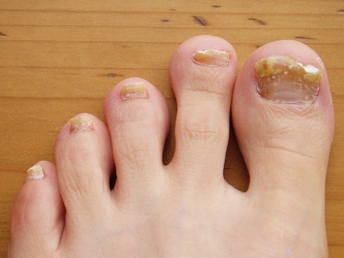 How to Get Rid of Toenail Fungus