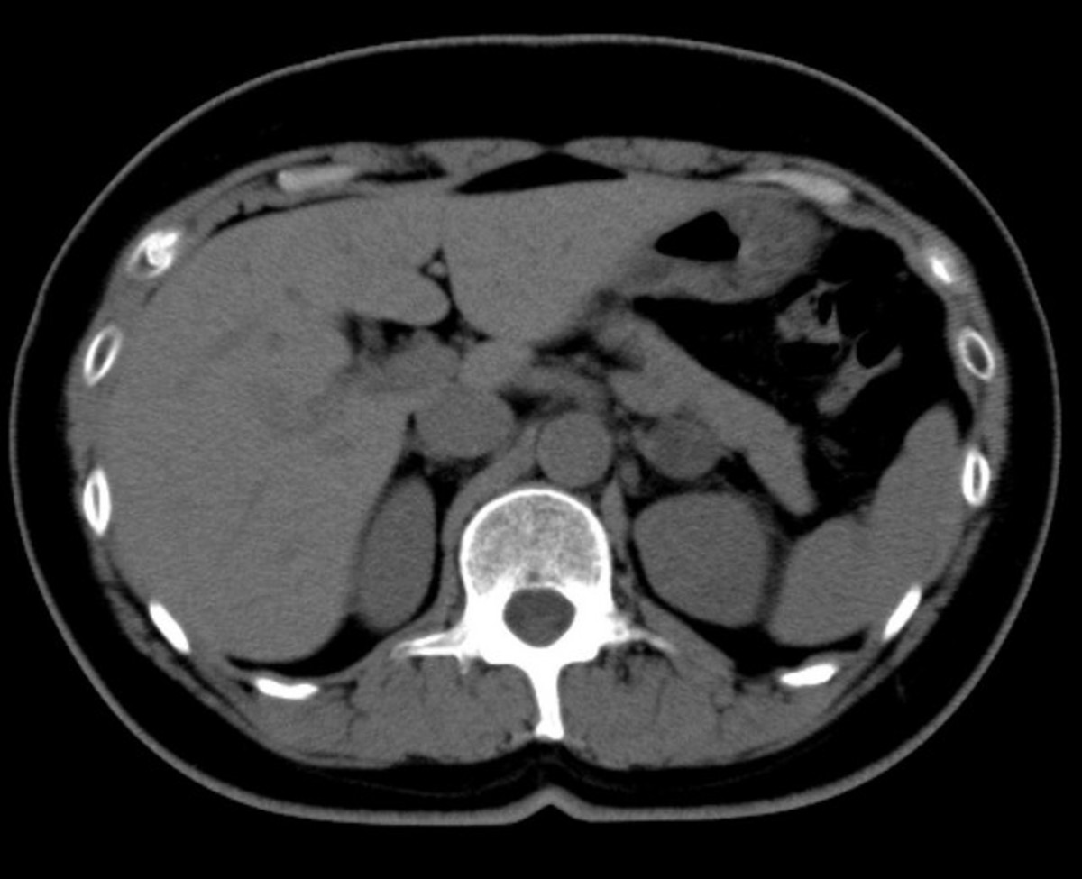CT of abdomen without contrast. Note the lack of distinction between abdominal organs.