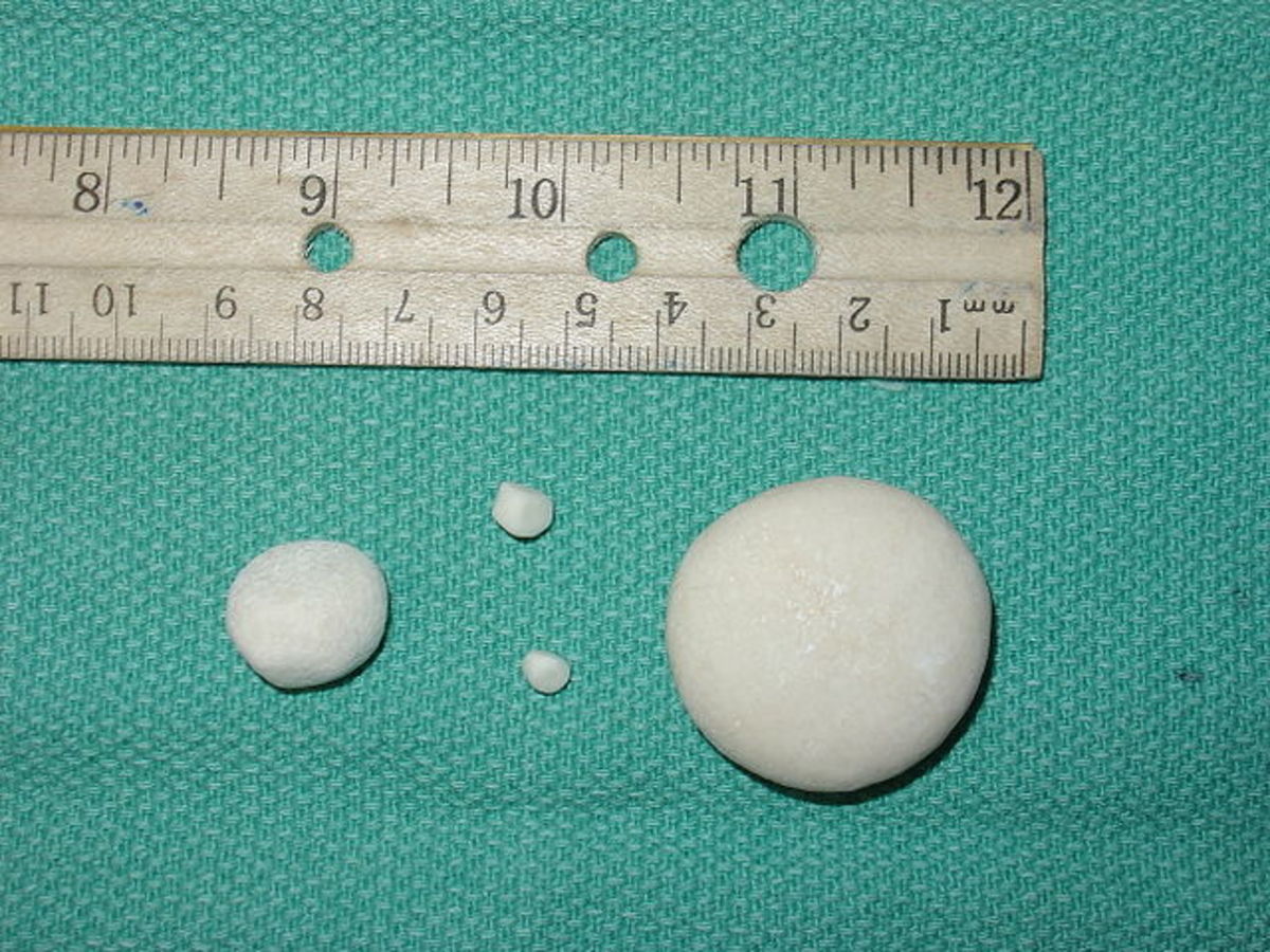 Struvite stones from dog's bladder.