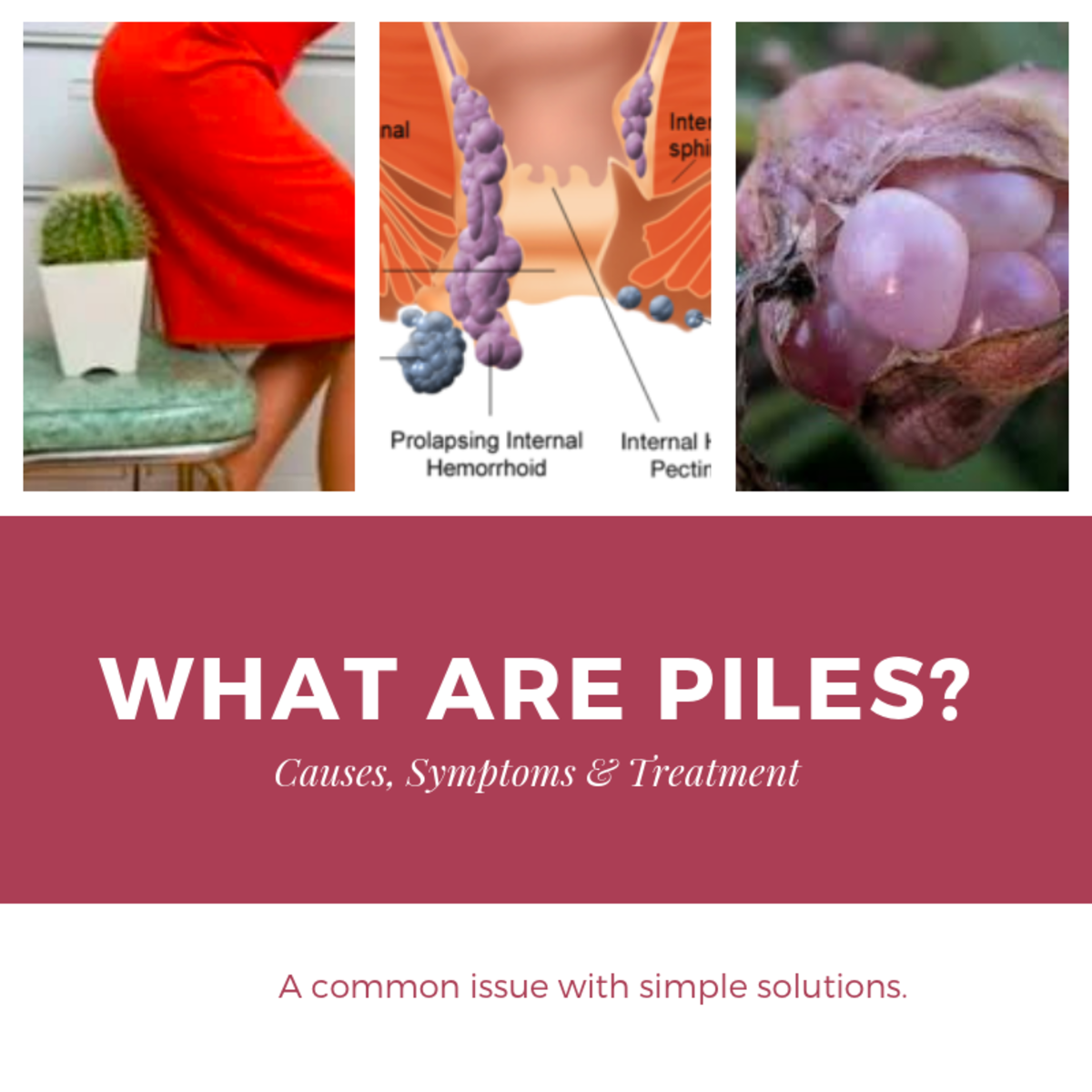 Entender Mal Electrodo Independientemente Piles Hemorrhoids Symptoms 