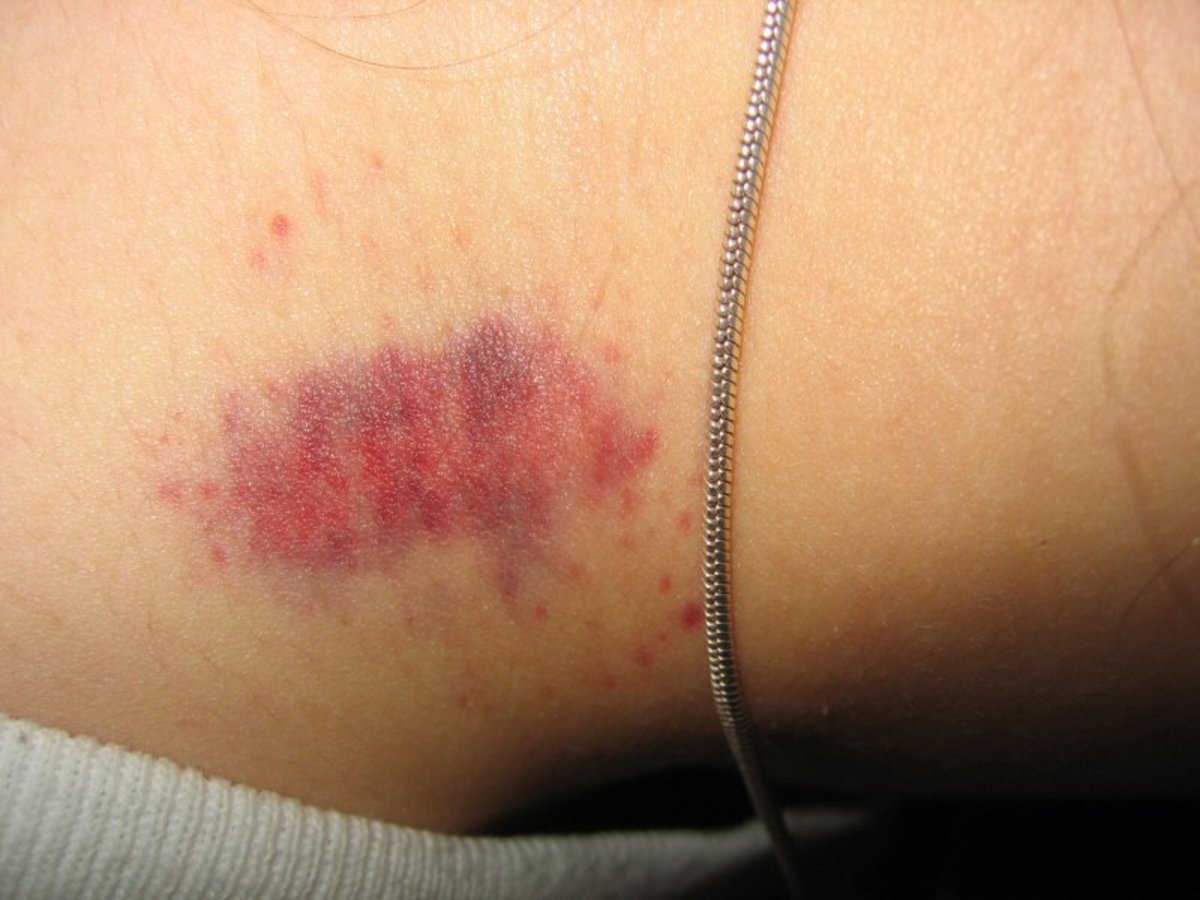 A very large and detailed hickey.