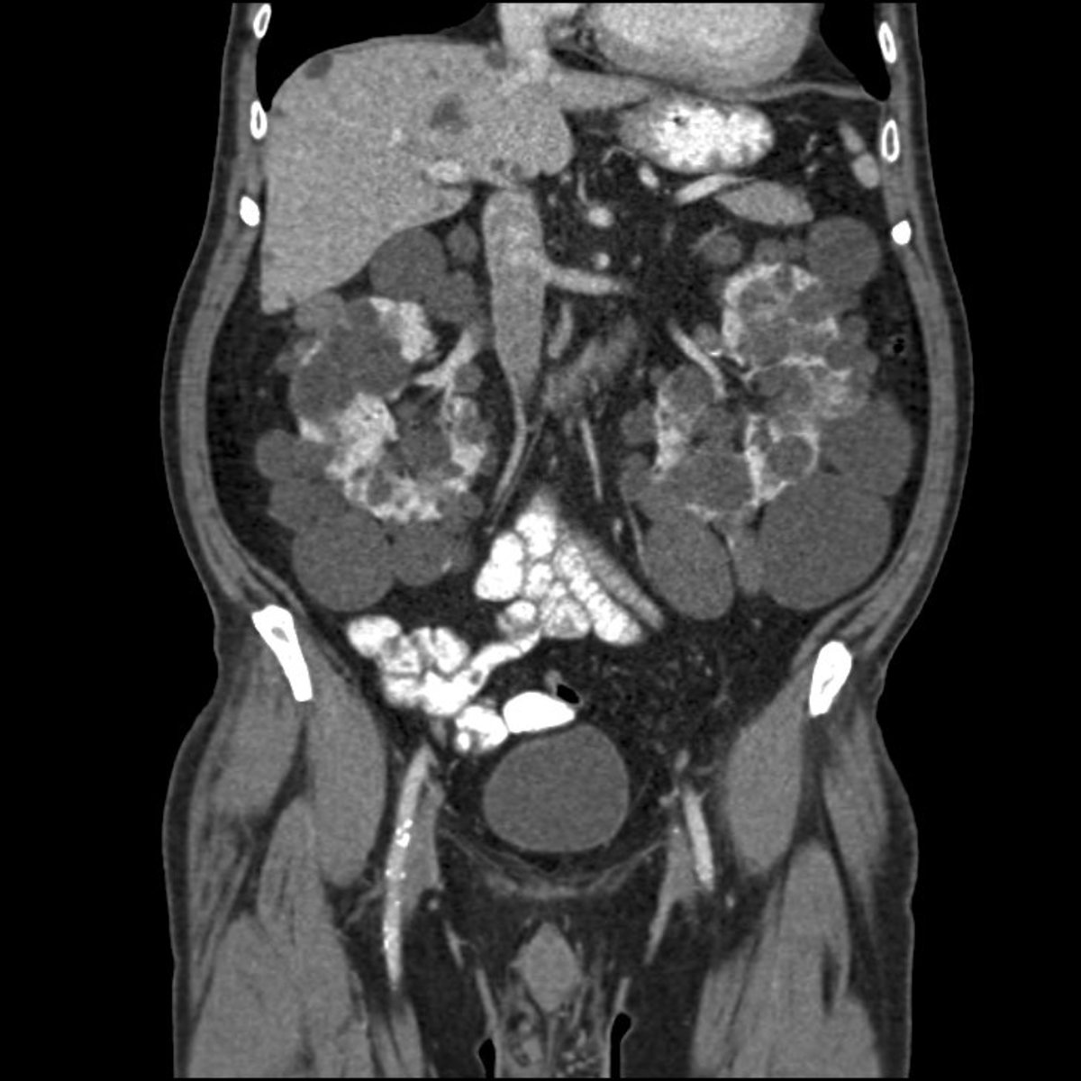 Abdominal CT scan of an adult with autosomal dominant polycystic kidney disease. Extensive cyst formation is seen over both kidneys, with a few cysts in the liver as well.