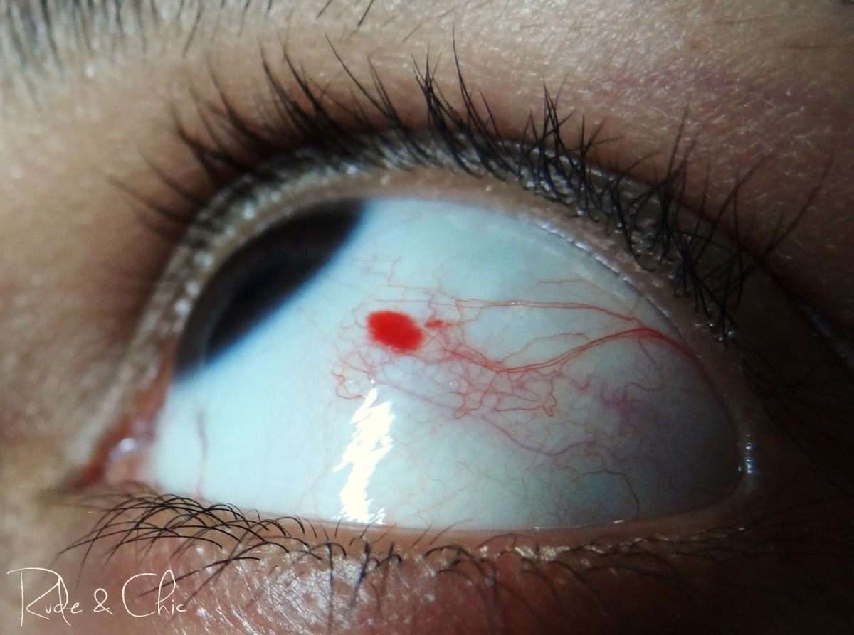 Causes of a Red Spot on Eye