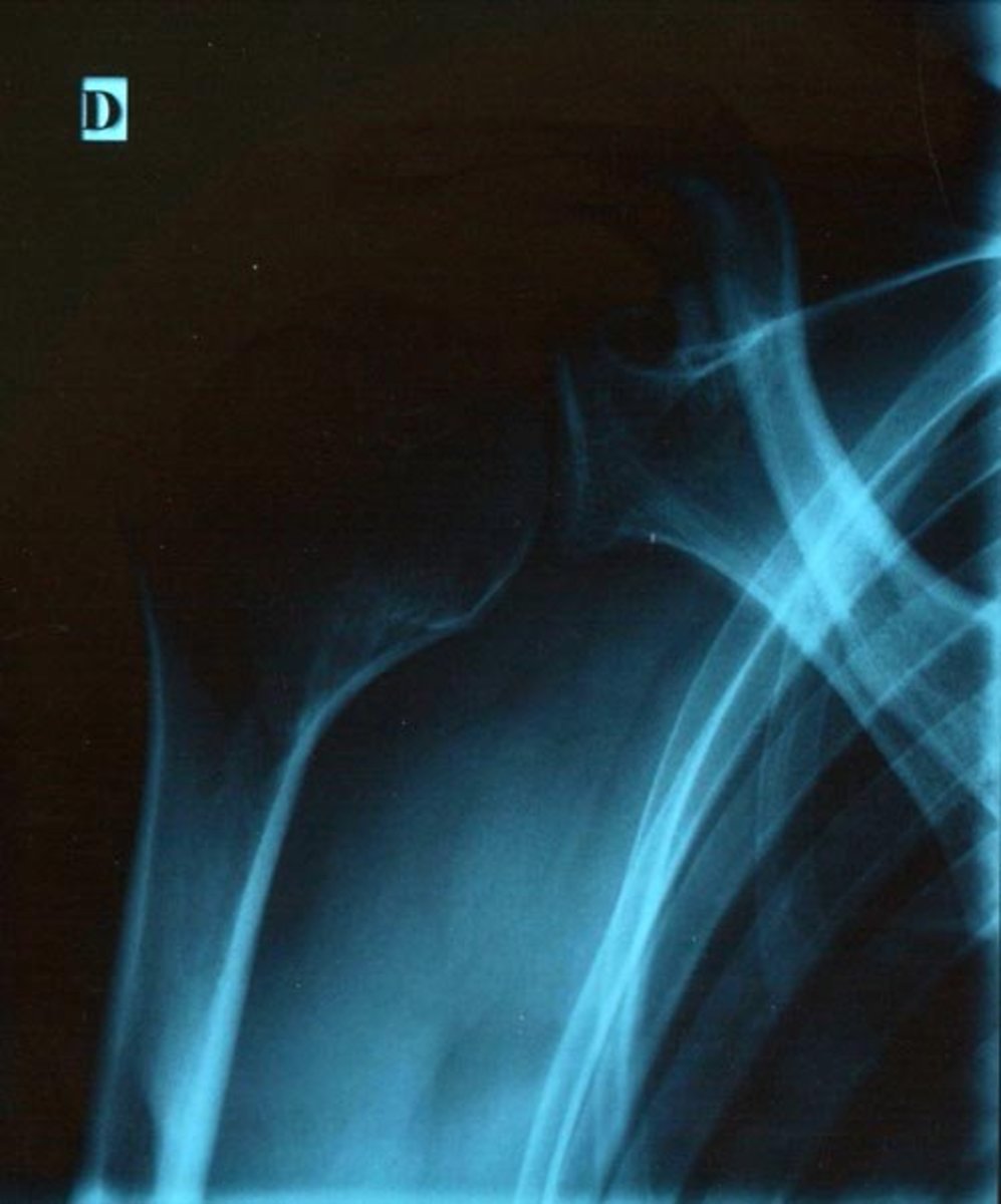 what-to-expect-on-the-day-of-arthroscopic-shoulder-surgery
