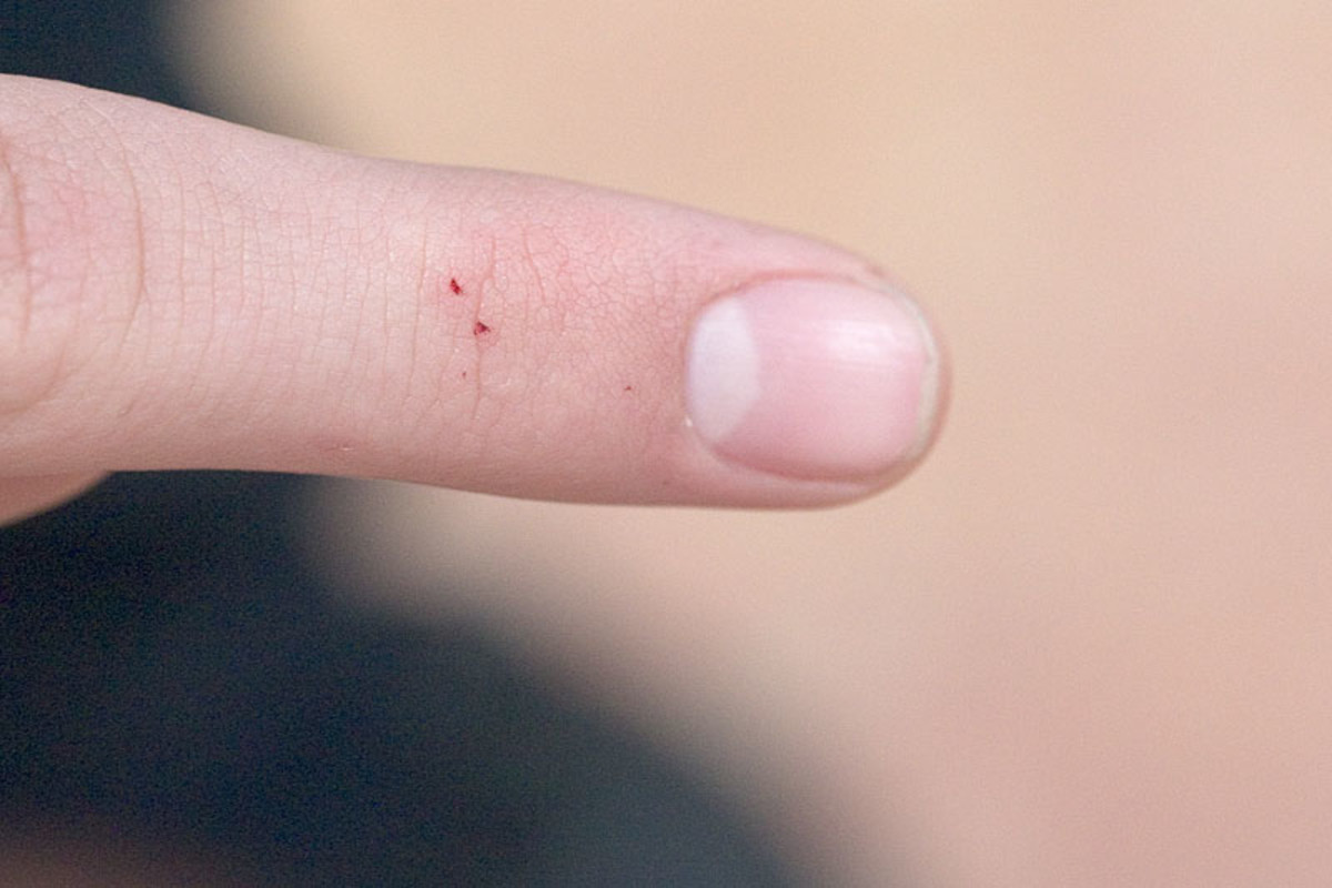 The two-pronged bite mark of a black widow spider. This bite took two weeks to heal, during which the victim experienced nausea.