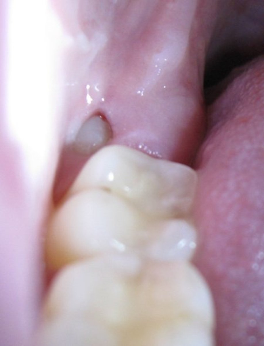 20 Tips for Treating Wisdom Tooth Pain