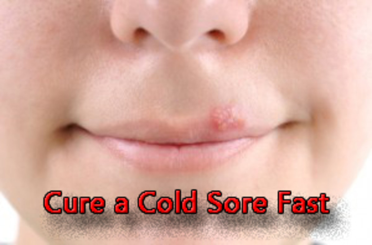 Get rid of a cold sore fast by treating it with these simple methods.