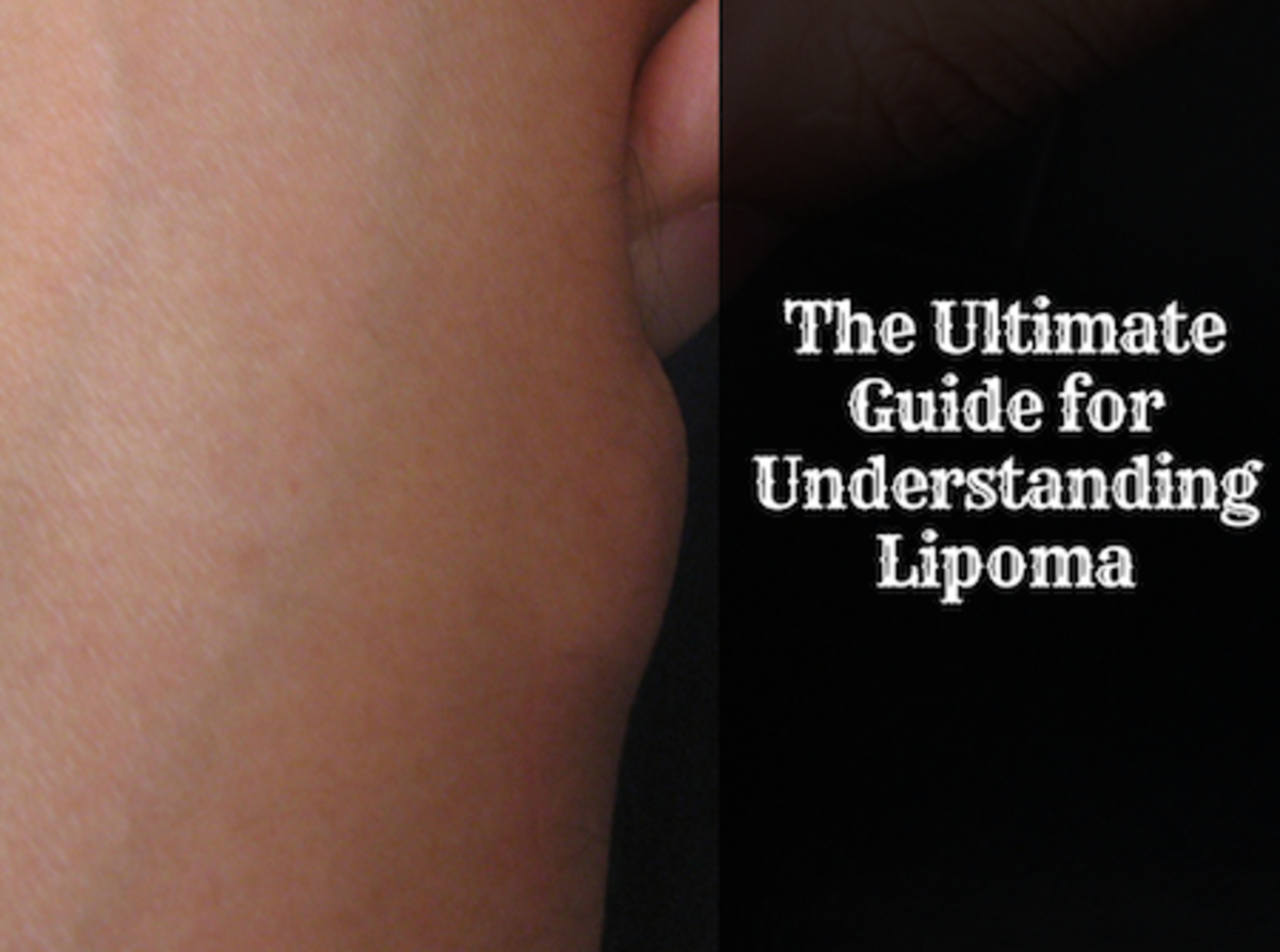 The Ultimate Guide for Lipoma: Causes, Symptoms, Diagnosis and Treatment