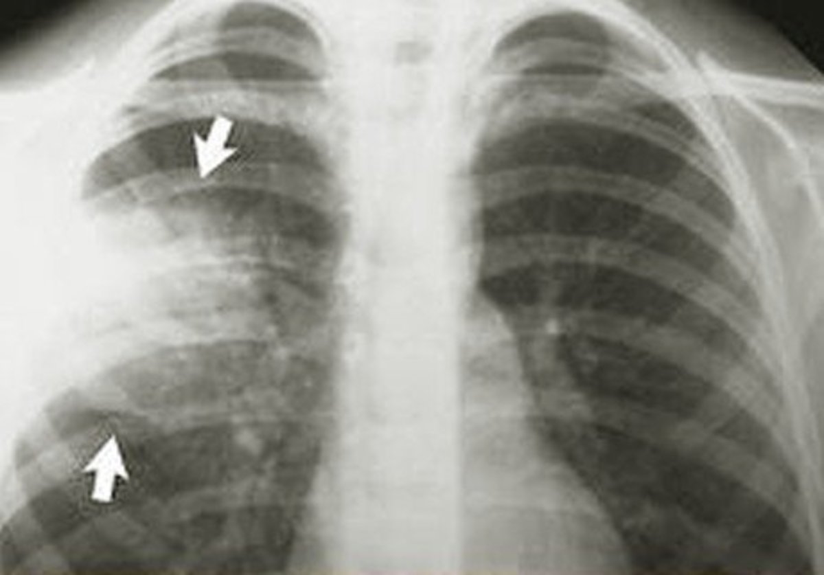 A chest X-ray showing the presence of pneumonia 