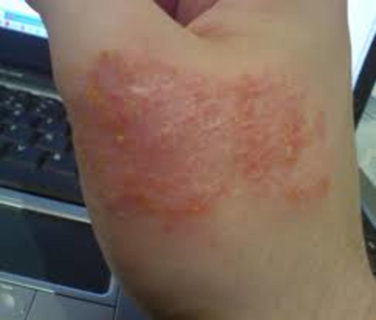 Eczematous rash with bacterial infection 