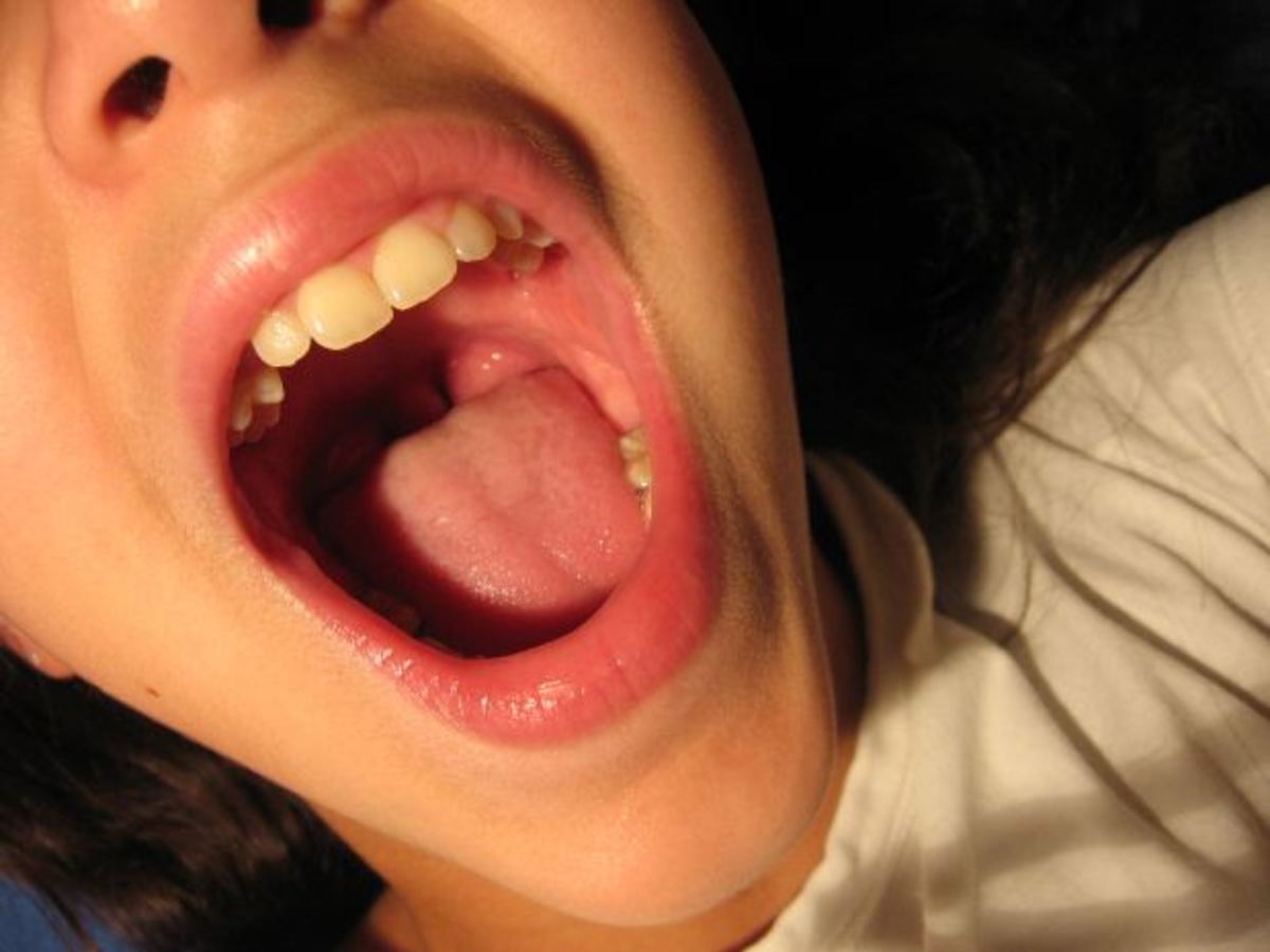Possible Causes for Bumps on the Roof of Your Mouth