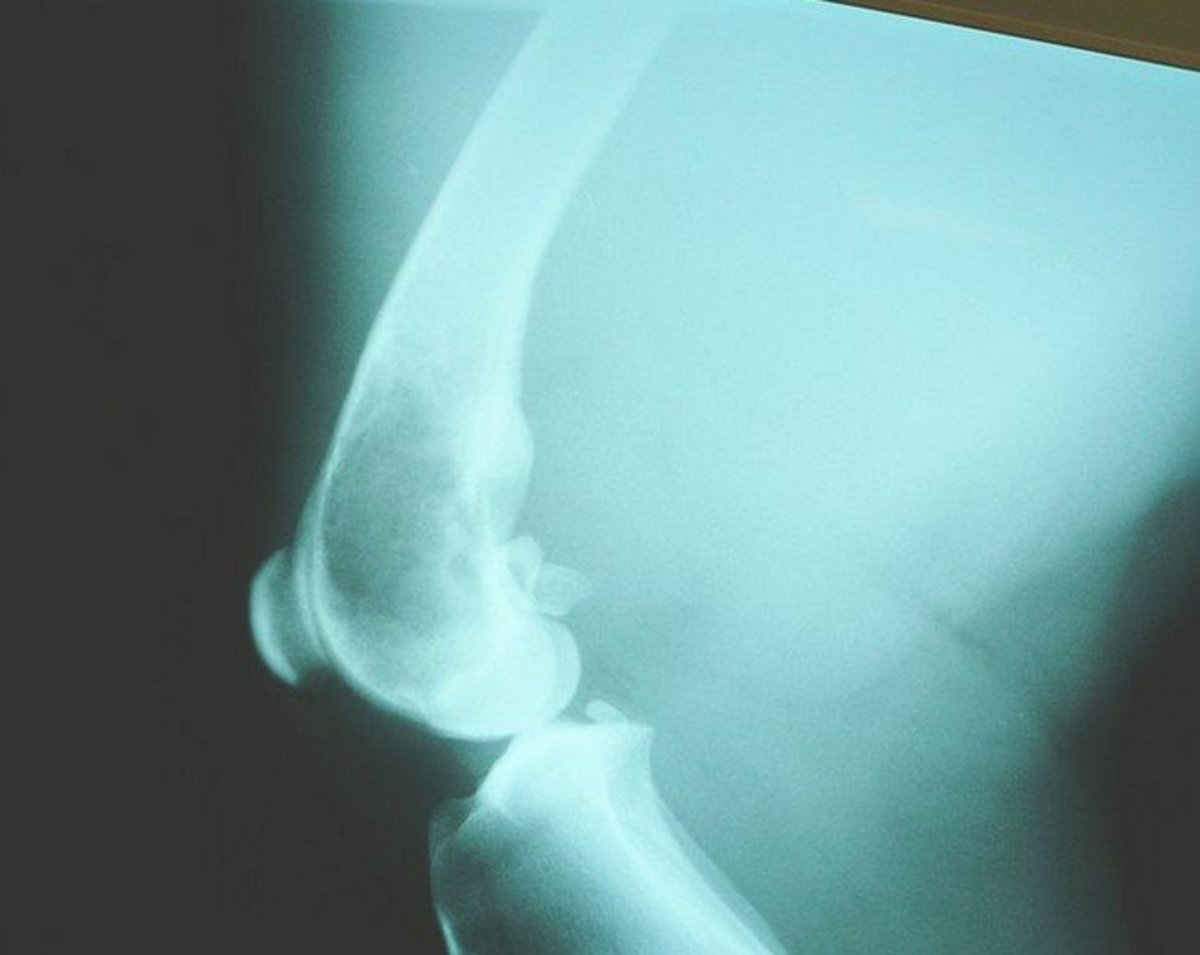 Lateral x-ray showing distal femur of a dog with osteosarcoma. Notice the large dark portion which is where the femur bone is being destroyed.