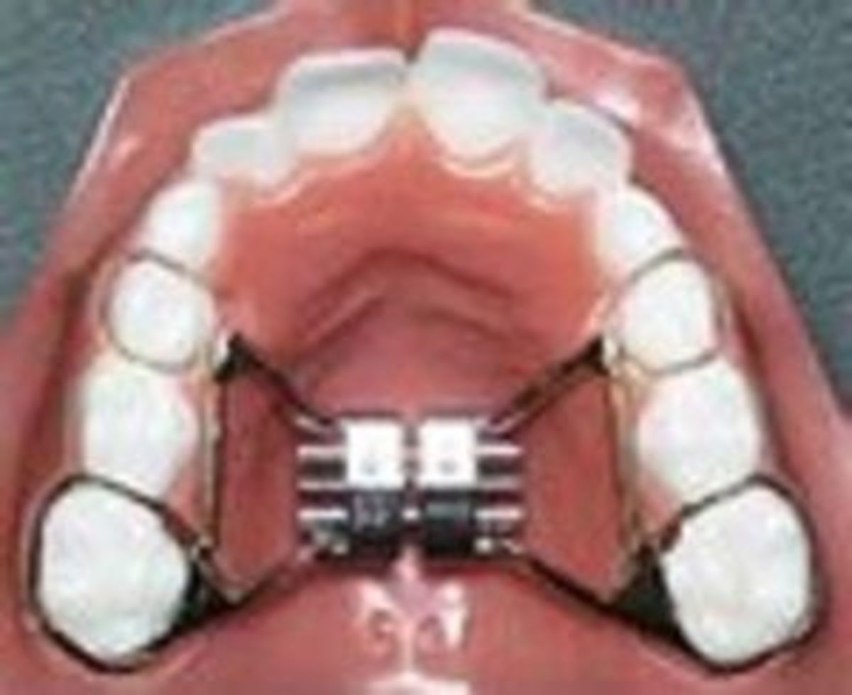Do you have an expander?
