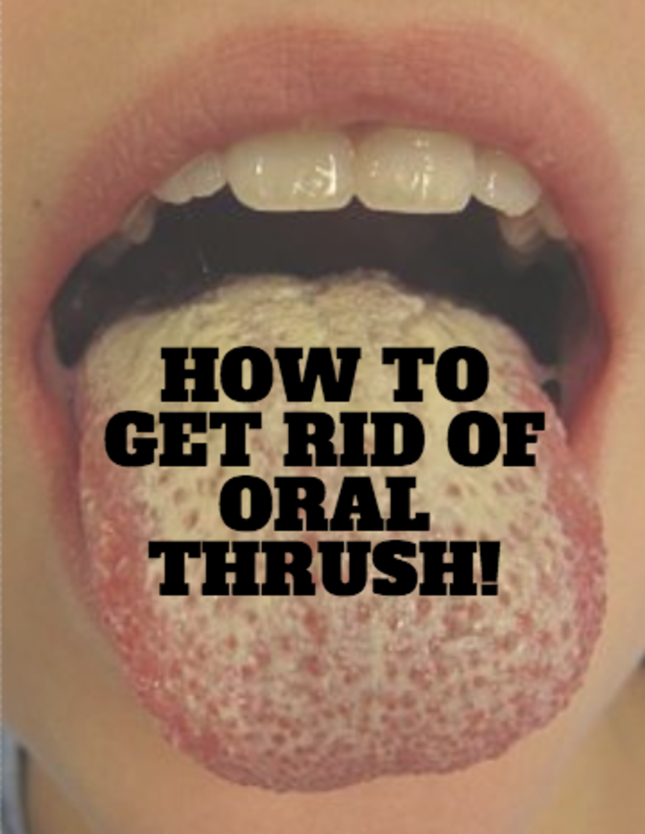 Get rid of oral thrush today!