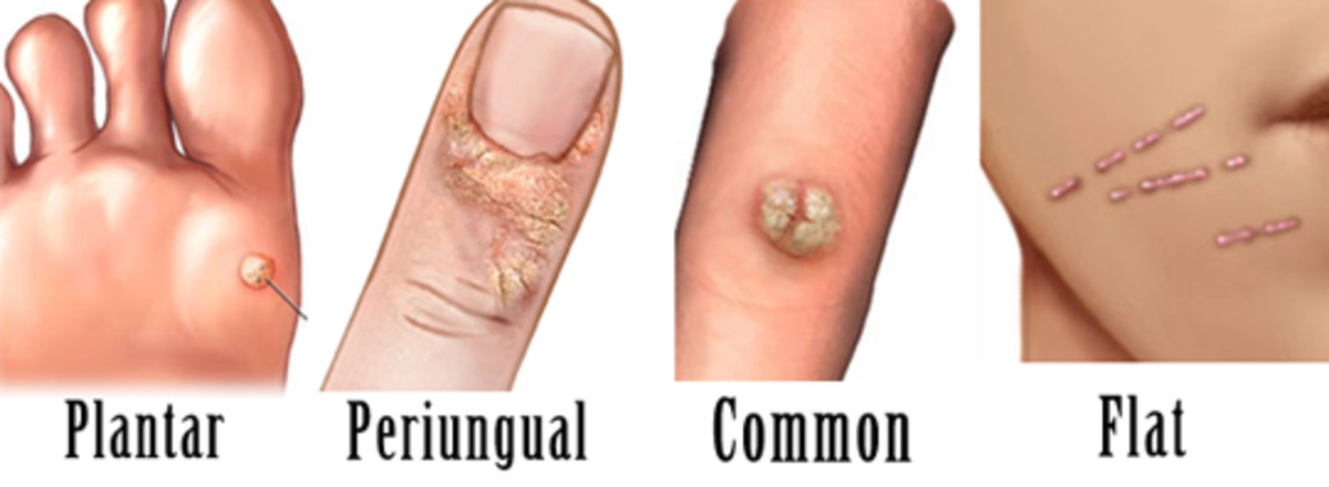 whats-the-best-way-to-get-rid-of-hand-warts