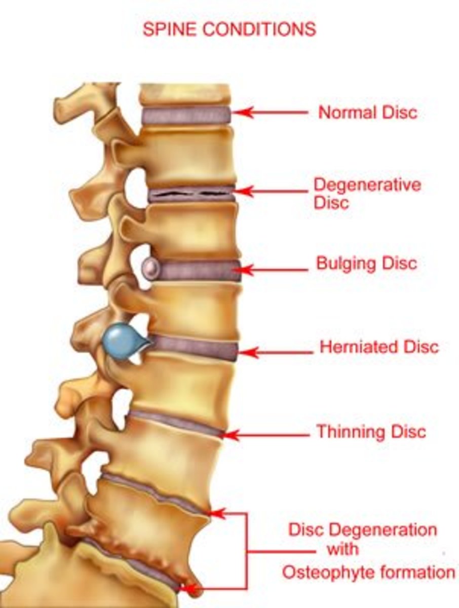 Herniated disks and other spinal conditions that can lead to sciatica related lower back pain 