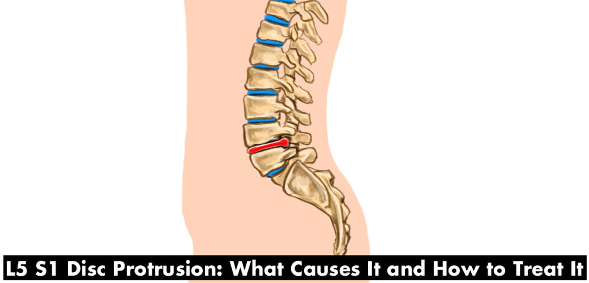 What causes L5 S1 Disc Protrusion and how to treat it.