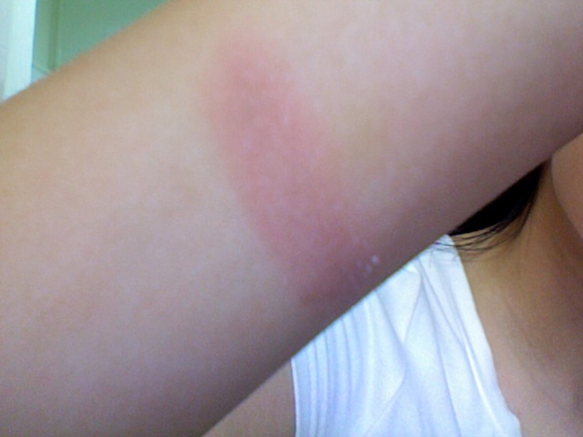 A first-degree burn after one day