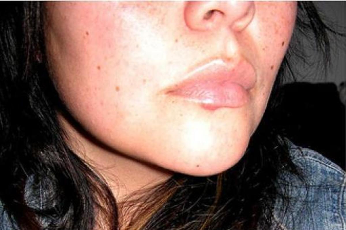 You no longer need to endure the embarrassment of cold sores. 